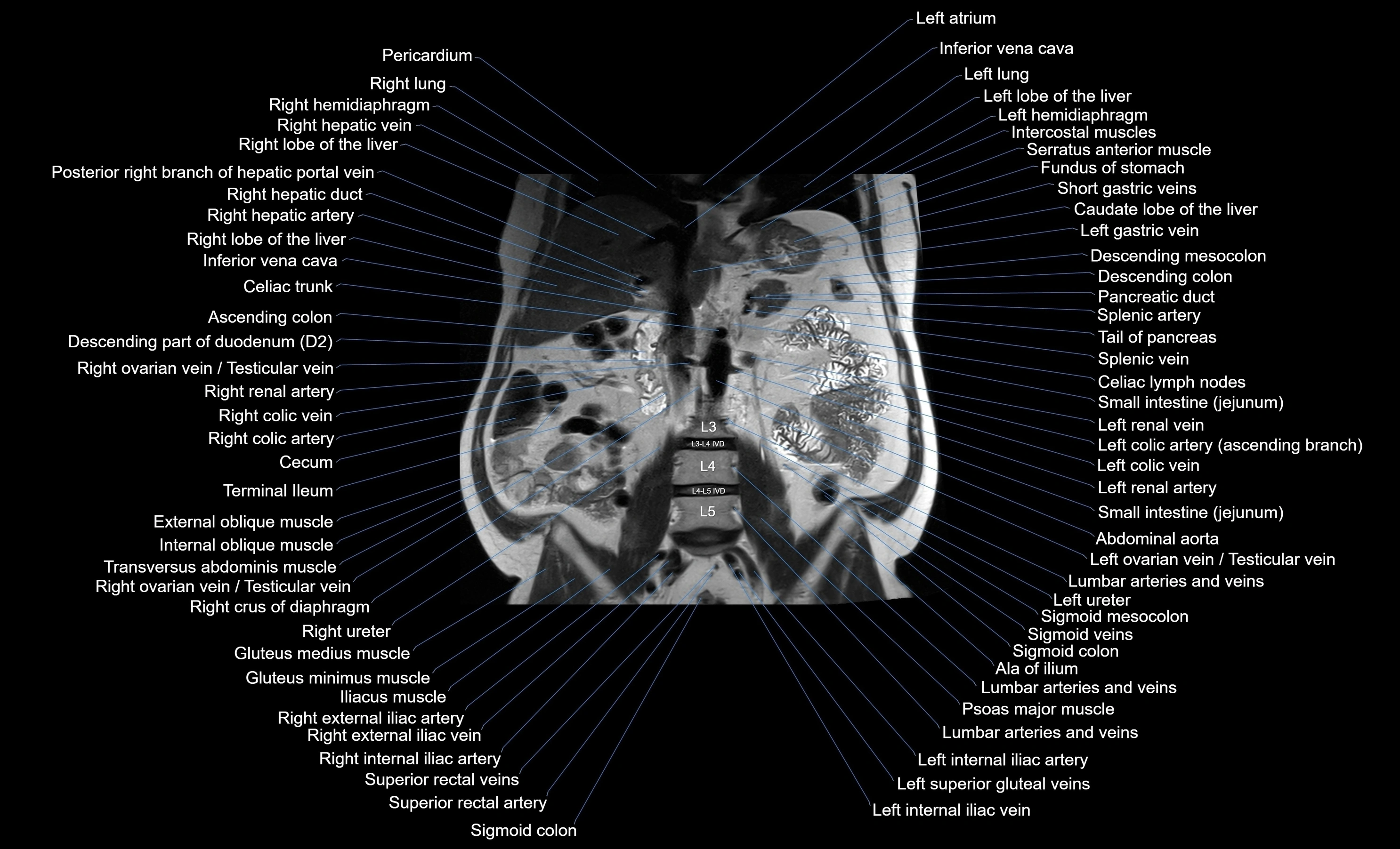 MRI Abdomen coronal labelled cross sectional anatomy radiology  image-img-00001-00032.webp